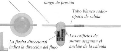 Colocación de derivación de hipertensión intracraneal idiopática